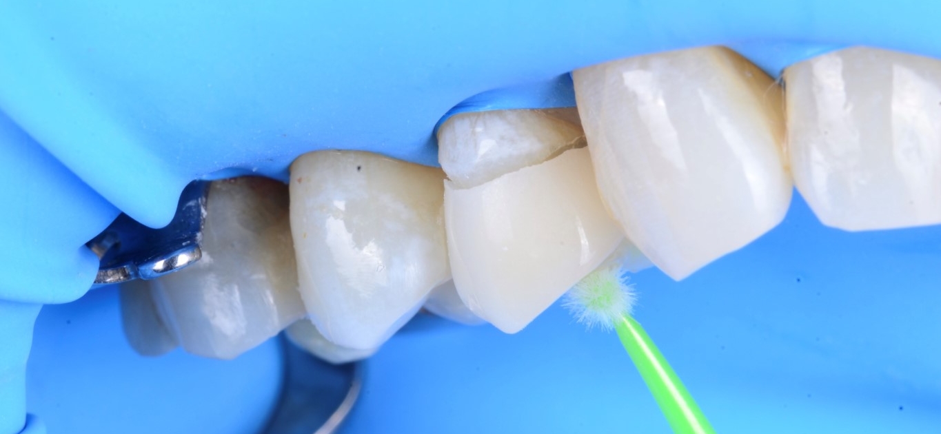 Réparation de la dent cassée