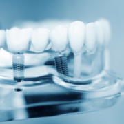 Modèle dentaire en plastique montrant des implants dentaires intégrés avec des couronnes, illustrant la structure et le placement des implants.